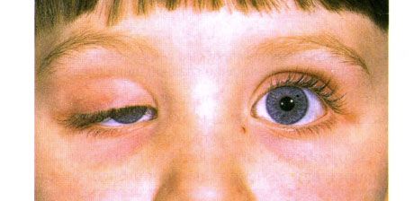 ஒருதலைப்பட்ச பிறவிக்குரிய ptosis