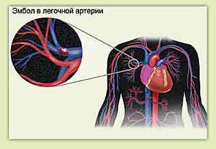 இடதுபுறத்தில் நுரையீரல் தமனிகளும் மார்பு வலிகளும்