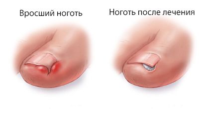 Ingrown ஆணி அகற்றுதல்