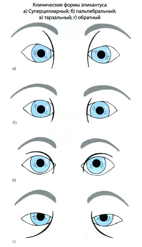 Epicanthus மருத்துவ வடிவங்கள்.  a) superciliary, b) தட்பவெப்பம், c) தடிமன், ஈ) தலைகீழ்